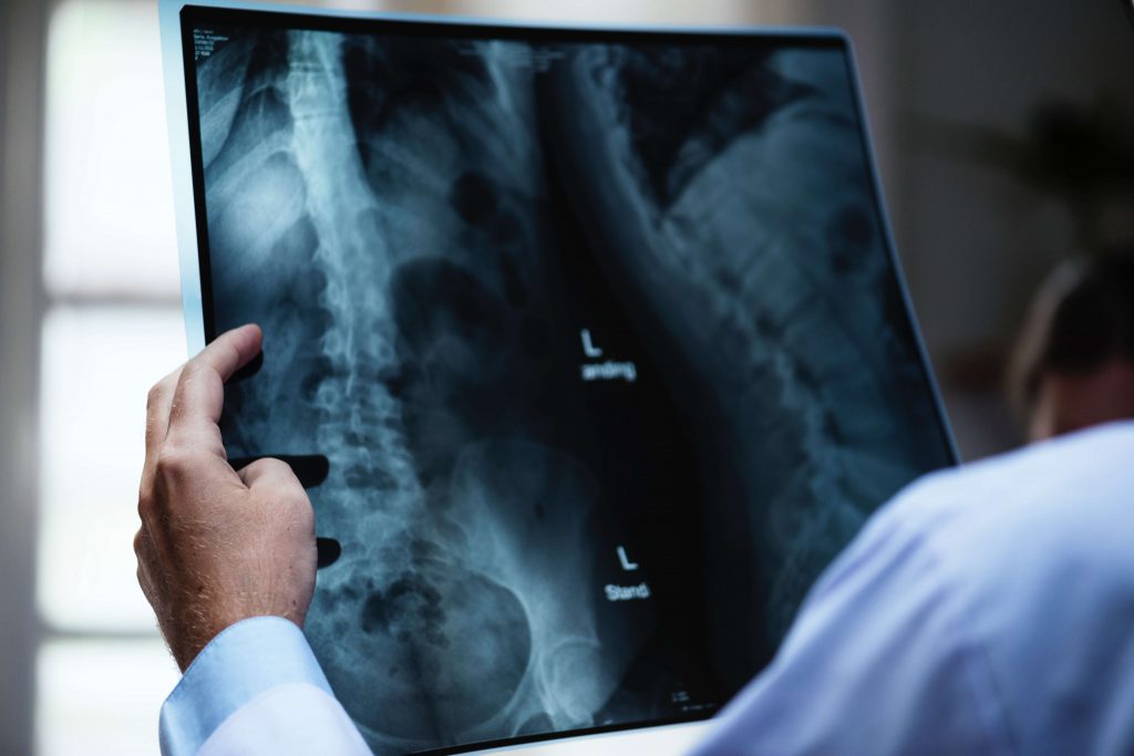 Chiropractor reviews x-ray films of a patient's thoracic and lumbar spine after a car accident.